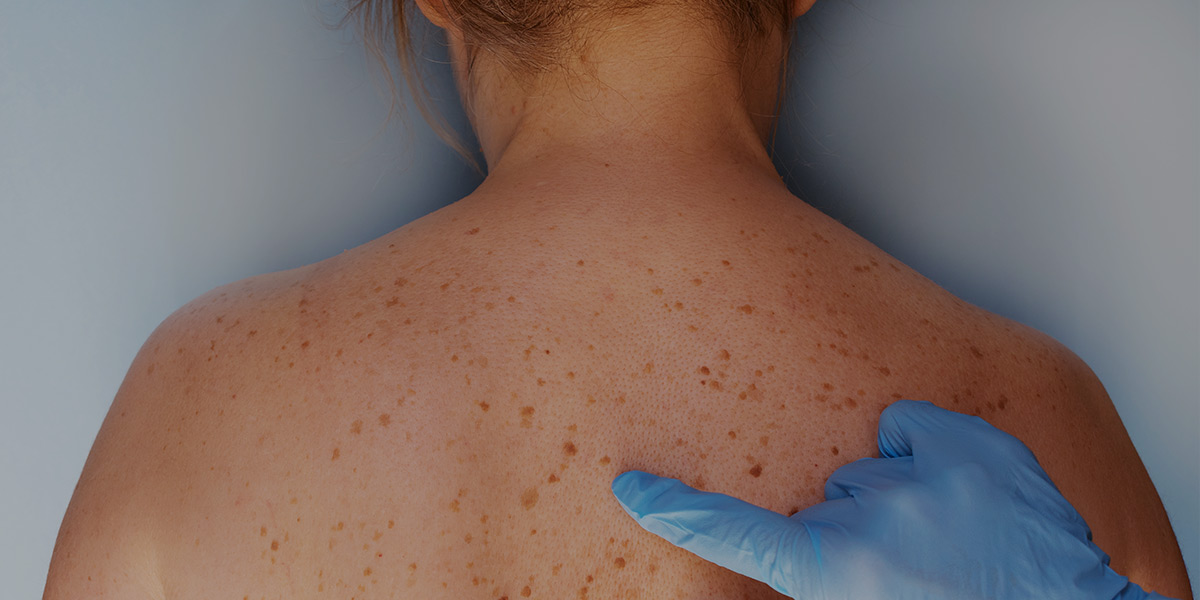 Dermatologe bei der Untersuchung des Patienten in der Klinik. Problemhaut mit Muttermalen. Nahaufnahme